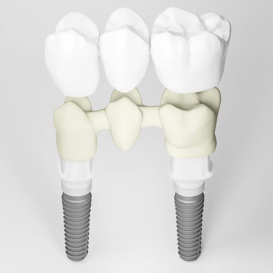 Zahnarzt Loerrach - Implantat Brücke