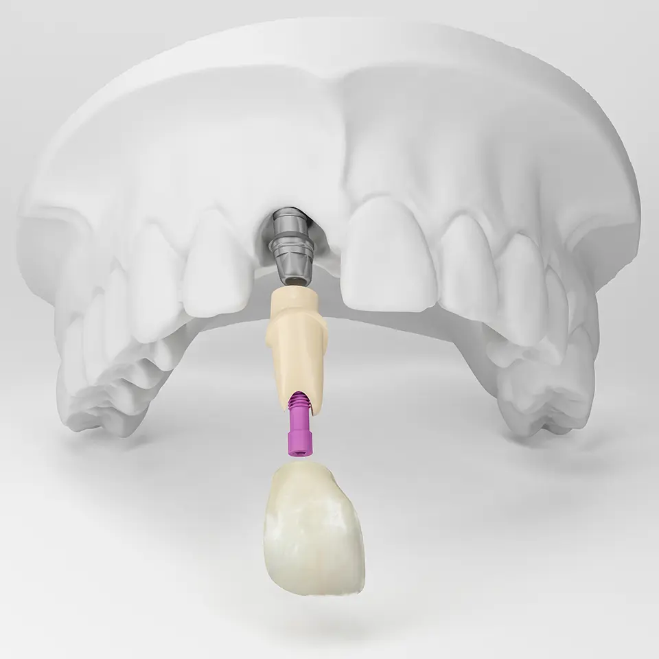 Zahnarzt Loerrach - Implantat Krone